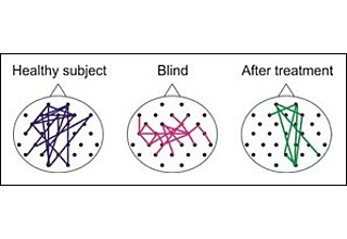 Mit Stromstößen gegen Blindheit - Neue Stromtherapie verbessert das Sehvermögen von Menschen mit Grünem Star