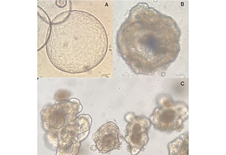 Beispielhafte mikroskopische Aufnahmen patientenspezifischer Organoidkulturen, die aus Gewebeproben von Darmtumorpatientinnen und -patienten der Klinik für Allgemein-, Viszeral-, Gefäß- und Transplantationschirurgie der Universitätsmedizin Magdeburg gewonnen wurden