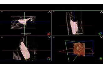 Detailbild zu :  Ultrasound Thyroid Imaging Fusion