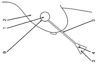 Breast Implant  - from patent application
