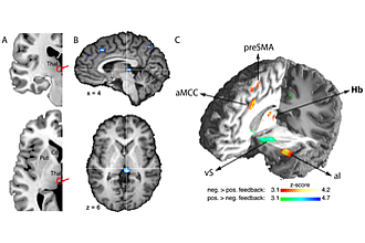 Ein Netzwerk aktivierter Hirnregionen bei der Handlungsüberwachung. (modifiziert nach Ullsperger & von Cramon, J Neurosci, 2003)