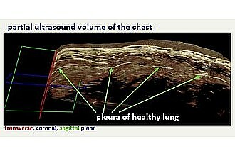 Detailbild zu :  Ultrasound of thoracic region - from 2D to 3D