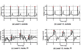 EKG-Ableitungen II und V3, die außerhalb (a)-(b) und innerhalb (c)-(d) eines 7T-MRT aufgezeichnet wurden.
