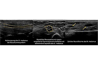 Detailbild zu :  Hochauflösende Sonographie der peripheren Nerven an Patienten mit Motoneuronerkrankungen