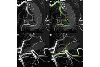 Visualization of hippocampal supply. Representation of the hippocampal supply using a maximum intensity projection of the 7 T ToF-angiography in MeVisLab. The hippocampal mask obtained from the T1-weighted sequence was adopted as an anatomical reference. In case of mixed hippocampal supply (A and B) the anterior choroidal artery (AchA, in violet) participates to the vascularization with an uncal branch (highlighted in pink) together with the hippocampal arteries (in yellow) which arise from the posterior cerebral artery (PCA, in green) or its branches. In case of single hippocampal supply (C and D) no uncal branch can be detected. From: Valentina Perosa, Anastasia Priester, Gabriel Ziegler, Arturo Cardenas-Blanco, Laura Dobisch, Marco Spallazzi, Anne Assmann, Anne Maass, Oliver Speck, Jan Oltmer, Hans-Jochen Heinze, Stefanie Schreiber*, Emrah Düzel* (eq.), Hippocampal vascular reserve associated with cognitive performance and hippocampal volume, Brain, Volume 143, Issue 2, February 2020, Pages 622–634, https://doi.org/10.1093/brain/awz383
