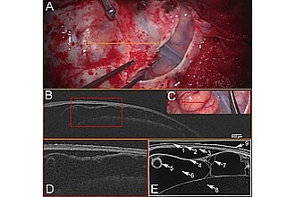 Detailbild zu :  Innovative Bildgebungstechniken für die neurochirurgische Führung