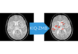 Zielstellung des Projektes ist die vollautomatische ZMB-Detektion in Routine-MRT-Aufnahmen und deren Abgrenzung von ZMB-Mimics..