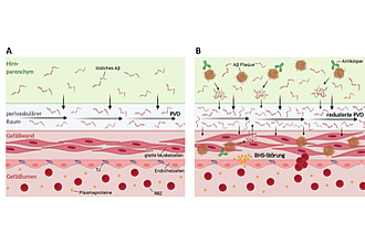 Pathophysiologie der ARIA ("Amyloid related imaging abnormalities"). Im physiologischen Zustand (A) wird Amyloid-β (Aβ) über perivaskuläre Räume aus dem Gehirn abtransportiert. (B) Bei der Alzheimer Erkrankung unter Immuntherapie (und gleichzeitig vorliegender, gestörten perivaskulären Drainage, PVD) führt die Akkumulation von Aβ in der Gefäßwand zu einer gestörten Gefäßintegrität inkl. einer Blut-Hirn-Schranken (BHS)-Störung mit Verringerung der Tight-Junction-Proteine (TJ), Erhöhung der Gefäßwanddurchlässigkeit, u.a. für Erythrozyten (rote Blutzellen, RBZ), Ödembildungen (ARIA-E) und Blutungen (ARIA-H). Modifiziert nach Greenberg et al. 202019 und aus Henneicke et al. "Die inflammatorische Variante der Zerebralen Amyloidangiopathie – ein Update", Ärztliche Praxis Neurologie Psychiatrie.