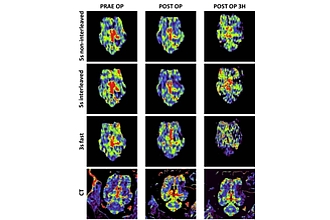 Perfusions-Parameterkarten des Cerebralen Blutvolumens (CBV)