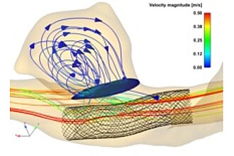 Detailbild zu :  Modellierung und Beeinflussung von Strömungen in Aneurysmen