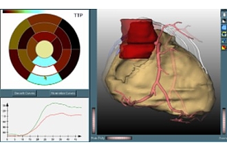 Auswertung von Perfusionsdaten des Herzens im Zusammenhang mit einer CT-Angiographie.