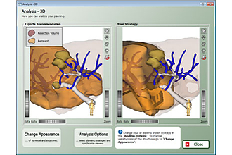 Mit dem LiverSurgeryTrainer können angehende Chirurgen die Planung von Eingriffen an der Leber auf der Basis von aktuellen Fällen intensiv trainieren.