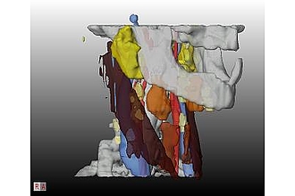 3D illustration of structures relevant for a neck lymph node removal